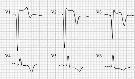 Left Ventricular Aneurysm • LITFL • ECG Library Diagnosis.